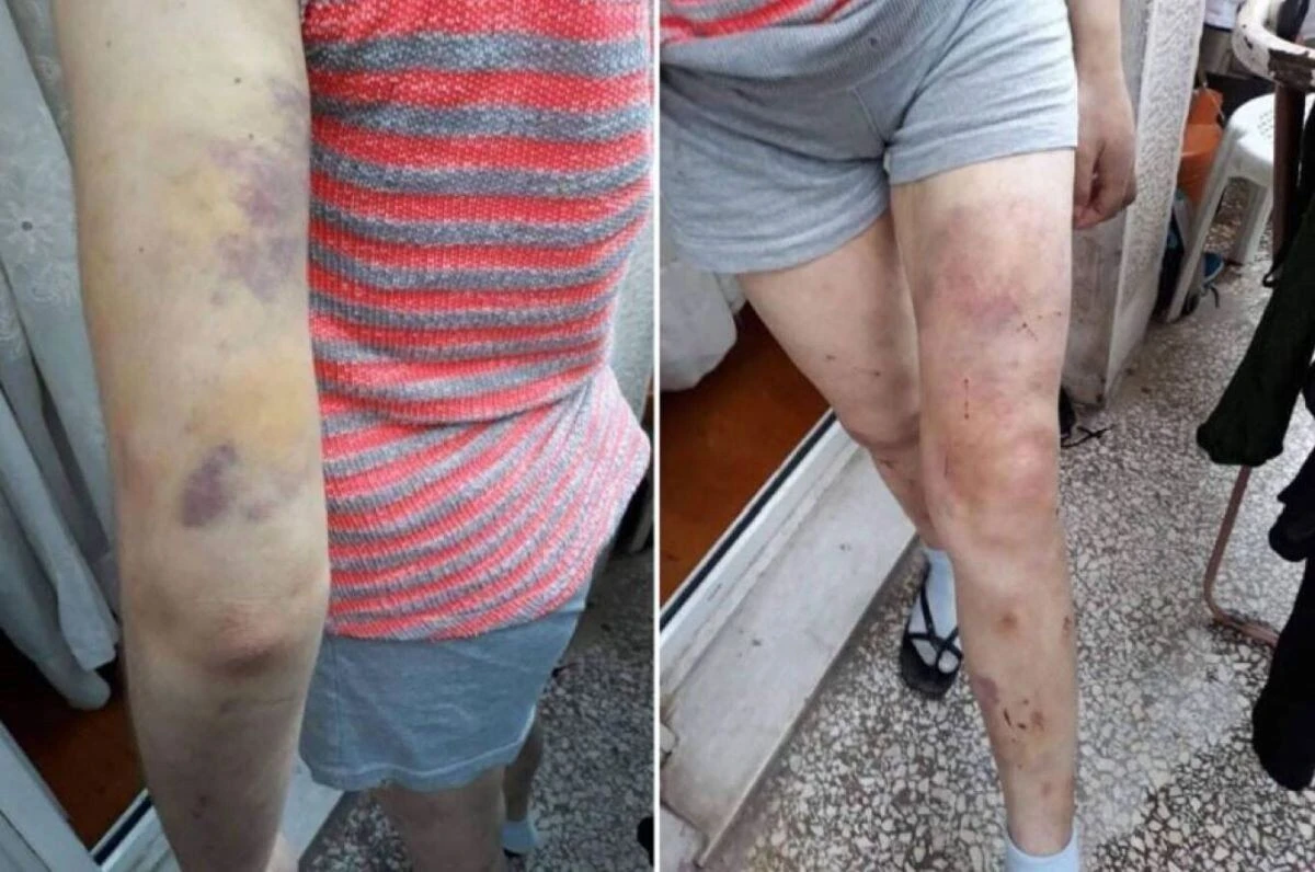 Η 23χρονη μετά από ξυλοδαρμό