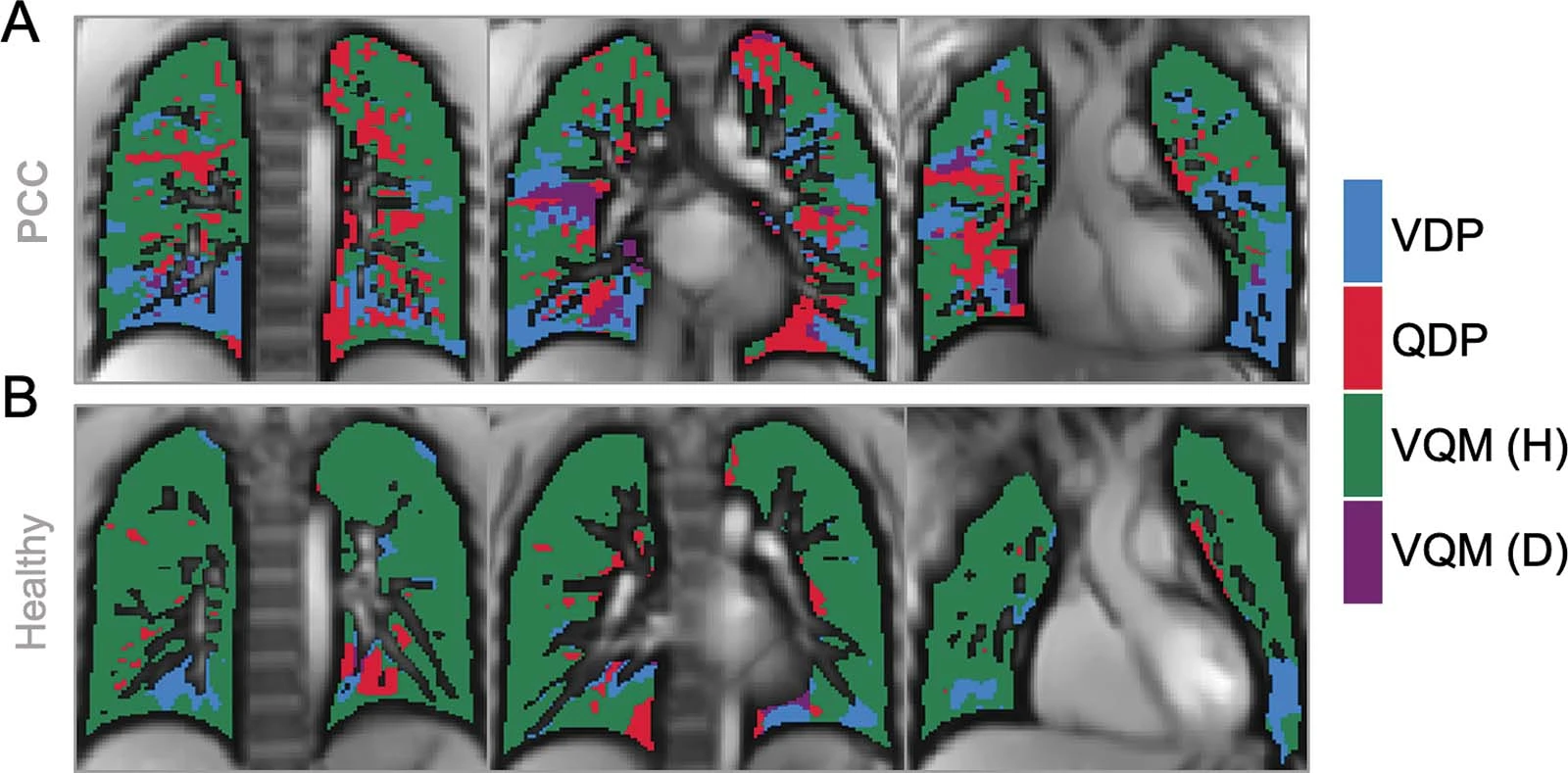 &nbsp;Φωτογραφίες που δείχνουν μειωμένη κίνηση αέρα και μειωμένη αιμάτωση σε 17χρονο ασθενή με μακροχρόνια Covid (PCC) και την κατάσταση των πνευμόνων υγιούς ασθενή