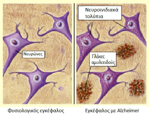 &nbsp;A. Εικόνα νευρώνων φυσιολογικού εγκεφάλου.&nbsp;B. Εικόνα νευρώνων εγκεφάλου με&nbsp;Alzheimer&nbsp;με χαρακτηριστικά την εμφάνιση των νευροινιδιακών τολυπίων στο εσωτερικό των νευρώνων (μέτρηση της πρωτεΐνης&nbsp;p-Tau217) και την εμφάνιση των πλακών αμυλοειδούς (μέτρηση του β-Αμυλοειδές 1-42 (Aβ42)