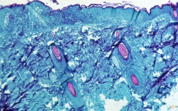 Ευλογιά των πιθήκων: Πρώτο κρούσμα και στις Φιλιππίνες
