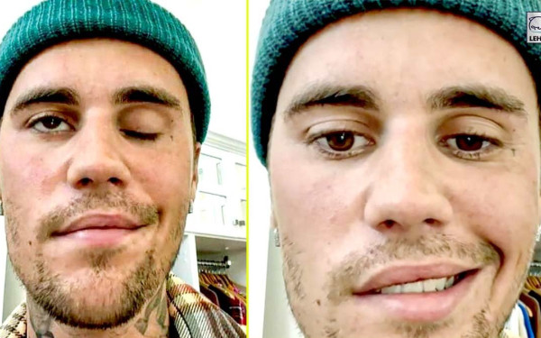 Ramsay Hunt: Το σύνδρομο που παρέλυσε τον Τζάστιν Μπίμπερ και πώς συνδέεται με παιδική ασθένεια