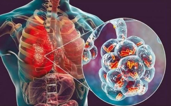 Η πρόγνωση, τα συμπτώματα και η αντιμετώπιση της πνευμονικής υπέρτασης	