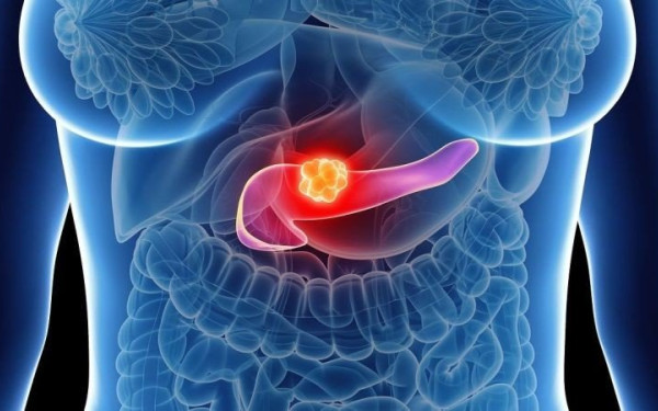  Καρκίνος του παγκρέατος: Οι ύποπτες ενδείξεις της πιο «σκληρής» μορφής της ασθένειας