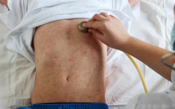 Ιλαρά: Αύξηση κρουσμάτων στην Ευρώπη – 7 θάνατοι σε δύο χώρες