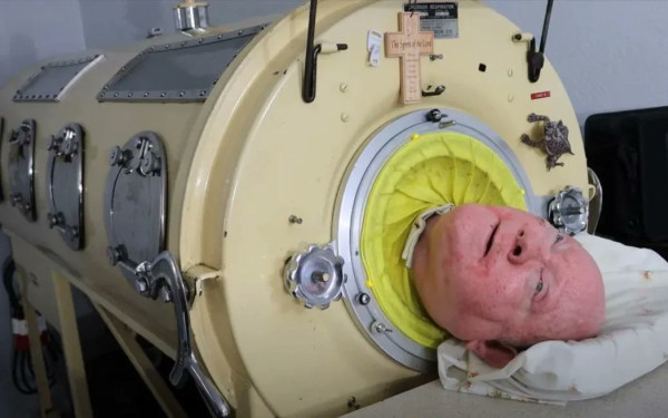 Πέθανε ο άνθρωπος που έζησε 72 χρόνια σε «σιδερένιο πνεύμονα»