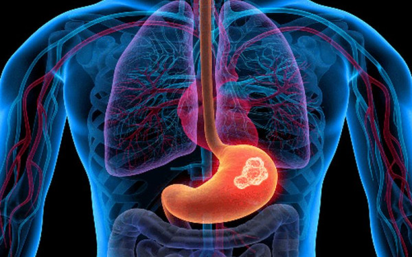 Ανησυχία από την αύξηση του καρκίνου στις νεαρές ηλικίες - Πού «χτυπάει» η νόσος