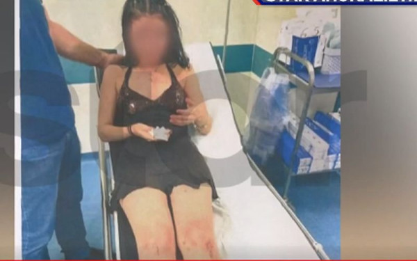 Χαλκίδα: «Με χτυπούσε με μπουνιές, έφτυνα αίμα» - Συγκλονίζει 19χρονη, θύμα ξυλοδαρμού από τον σύντροφό της