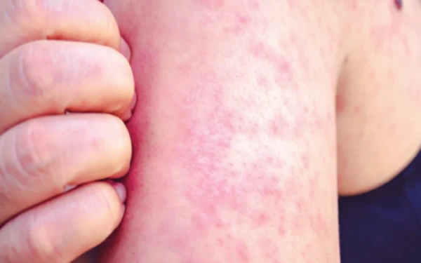 Συναγερμός για ιλαρά στην Αμερική λίγο πριν από το Μουντιάλ 2026