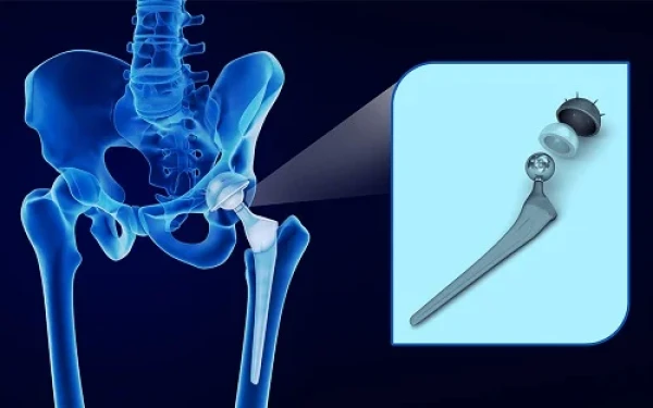 Μια ελληνική καινοτομία στη χειρουργική ισχίου κατακτά τον κόσμο ξεκίνησε από τη Θεσσαλονίκη