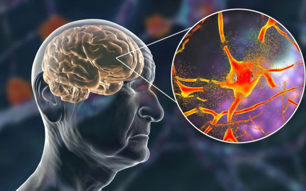 Πώς μπορεί η χρόνια λοίμωξη του εντέρου να οδηγήσει στο Αλτσχάιμερ