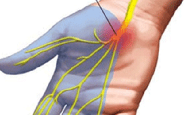 Το σύνδρομο καρπιαίου σωλήνα «προτιμά» γυναίκες και αφορά έως και το 5% του πληθυσμού