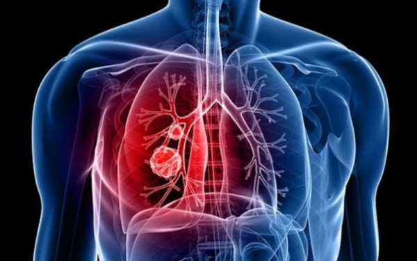 Καρκίνος πνεύμονα: Ο σοβαρός κίνδυνος που «κρύβεται» στο ντουλάπι της κουζίνας