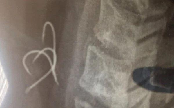 Αγρίνιο: 38χρονος έφαγε χταπόδι με αγκίστρι και του καρφώθηκε στον οισοφάγο (βίντεο)