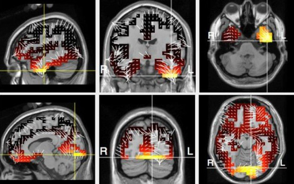 Θεσσαλονίκη - 2D-BioPAD: Έρευνα για δημιoυργία ψηφιακού εργαλείου έγκαιρη διάγνωσης Alzheimer
