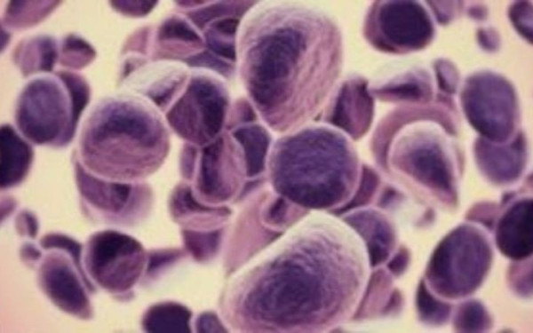 Το 40% των περιπτώσεων καρκίνου οφείλεται σε τροποποιήσιμους παράγοντες κινδύνου