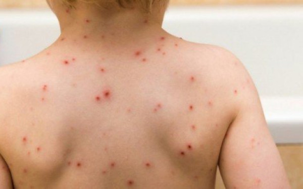 Π.Ο.Υ: 30 φορές περισσότερα κρούσματα ιλαράς στην Ευρώπη μέσα σε έναν χρόνο