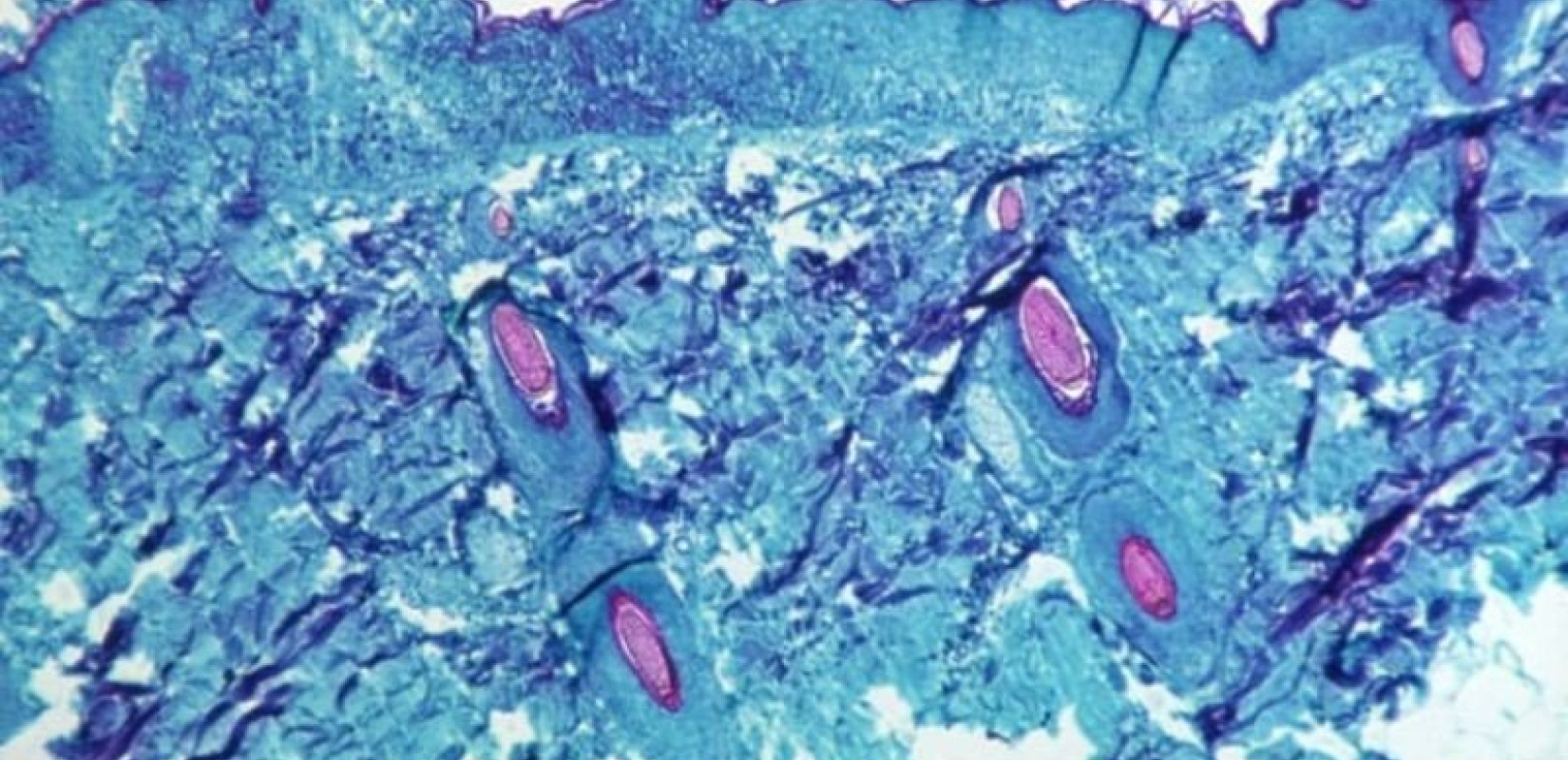 Αγωνία για το ύποπτο κρούσμα ευλογιάς των πιθήκων στο "Παπαγεωργίου": Σήμερα τα αποτελέσματα από το ΑΠΘ