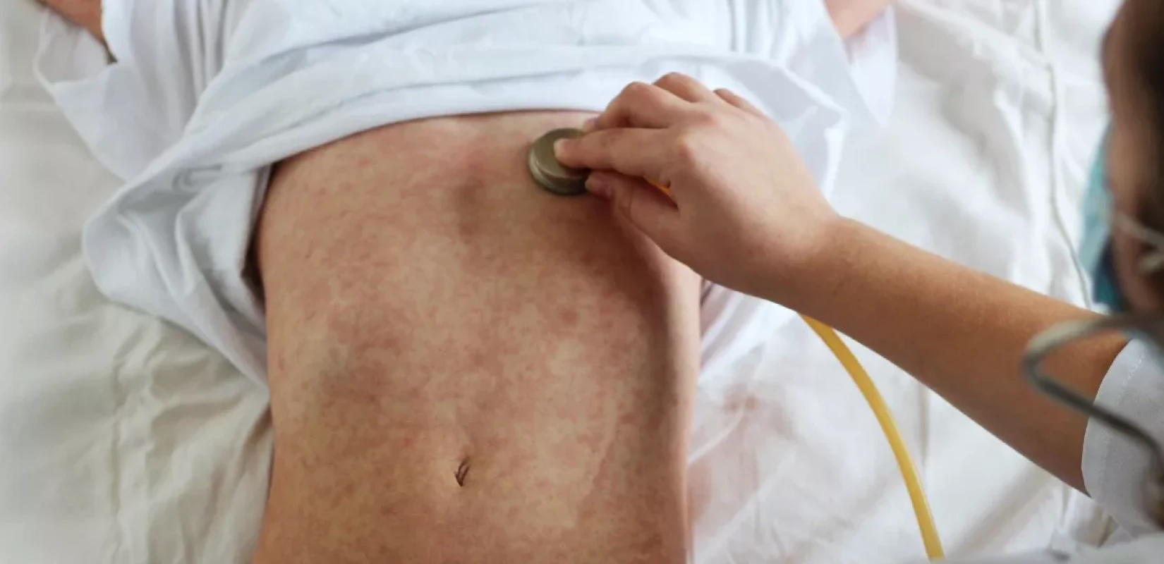 Ιλαρά: Αύξηση κρουσμάτων στην Ευρώπη – 7 θάνατοι σε δύο χώρες