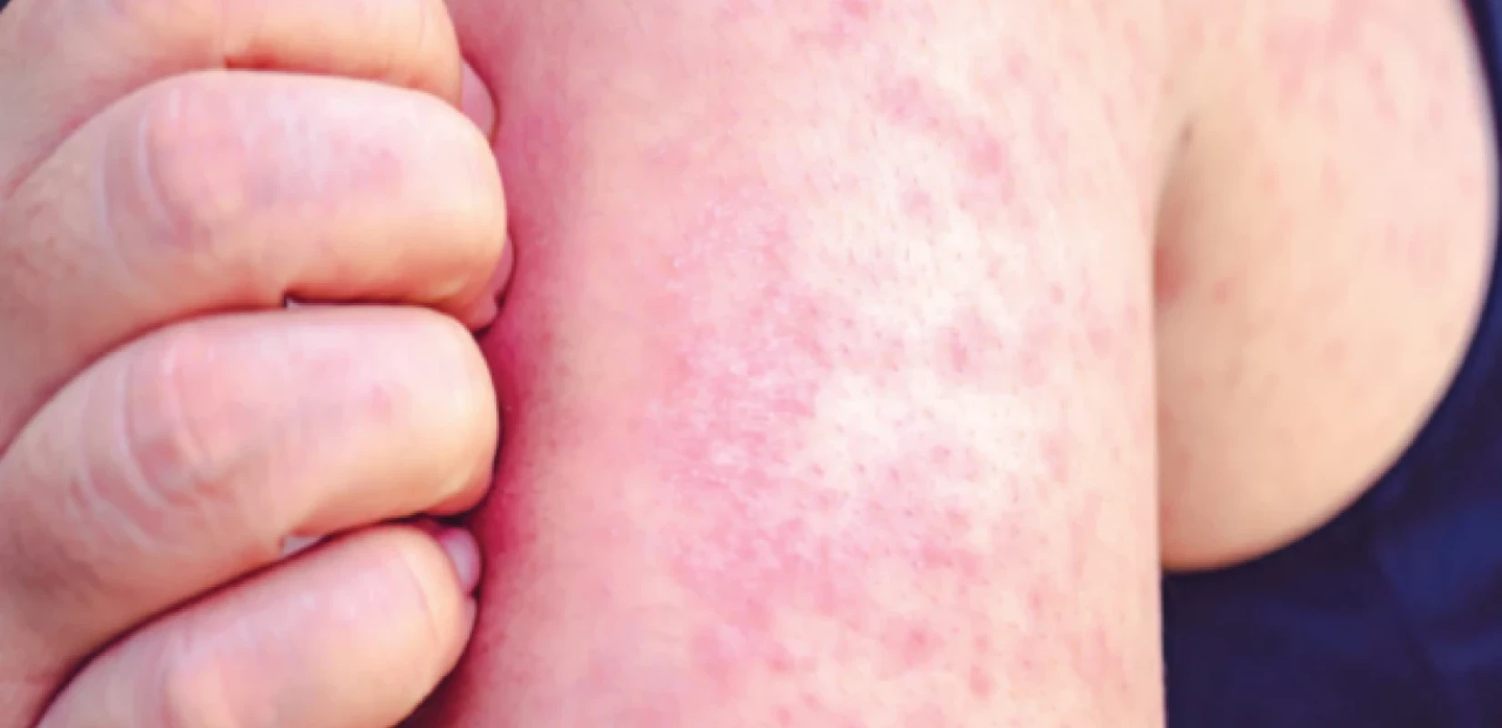 Συναγερμός για ιλαρά στην Αμερική λίγο πριν από το Μουντιάλ 2026