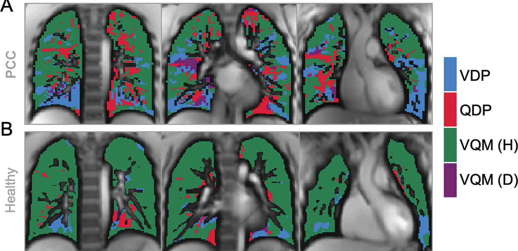 Πώς η long Covid μπορεί να επηρεάσει τους πνεύμονες των παιδιών