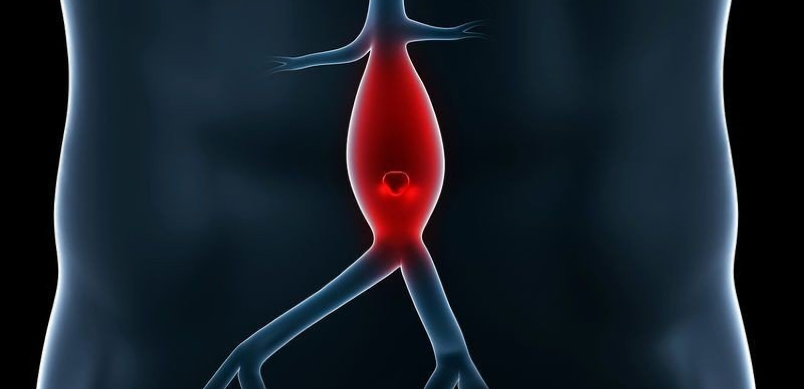 Δήμος Πέλλας: Δωρεάν προληπτικός έλεγχος για το ανεύρυσμα κοιλιακής αορτής